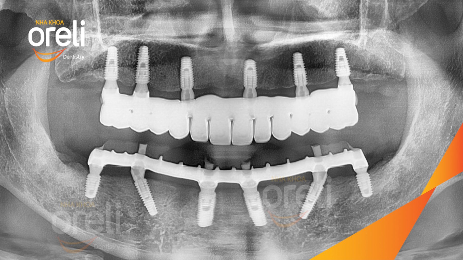 Mất răng toàn bộ hàm trên và hàm dưới trước khi điều trị tại Nha khoa Oreli