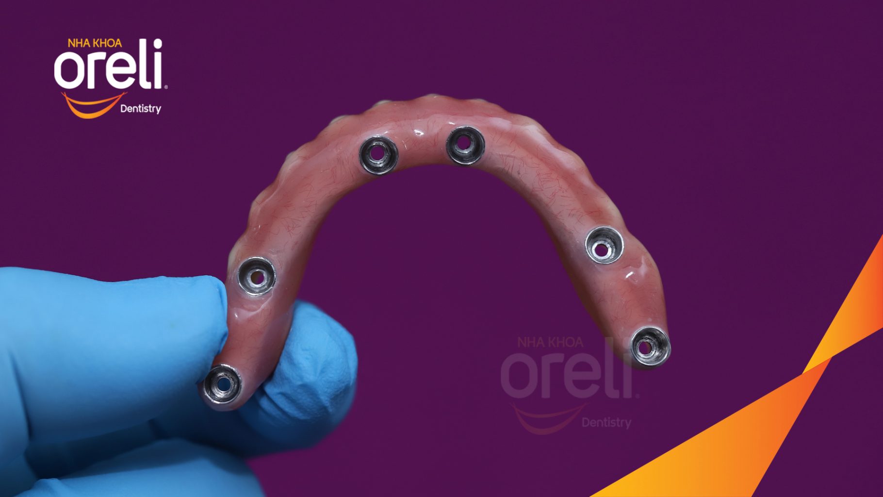 Quá trình Trồng răng implant hai hàm với phục hình tạm trong 7 ngày tại Nha khoa Oreli