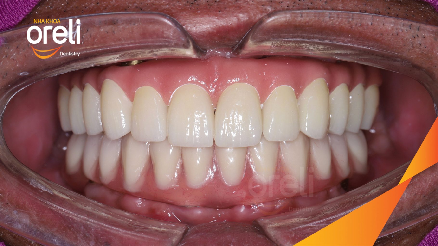 Thực hiện Trồng răng implant hai hàm với phục hình tạm kéo dài 7 ngày tại Nha khoa Oreli