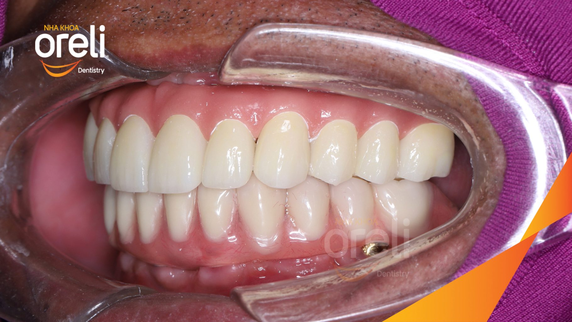 Trước điều trị: Mất răng toàn bộ hàm trên và hàm dưới tại Nha khoa Oreli