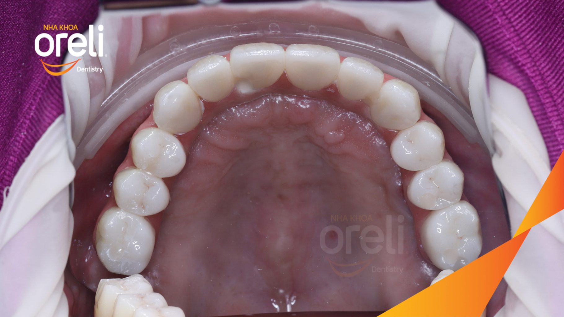 Kết quả sau 7 ngày: Ăn nhai trở lại và nụ cười thẩm mỹ tại Nha khoa Oreli