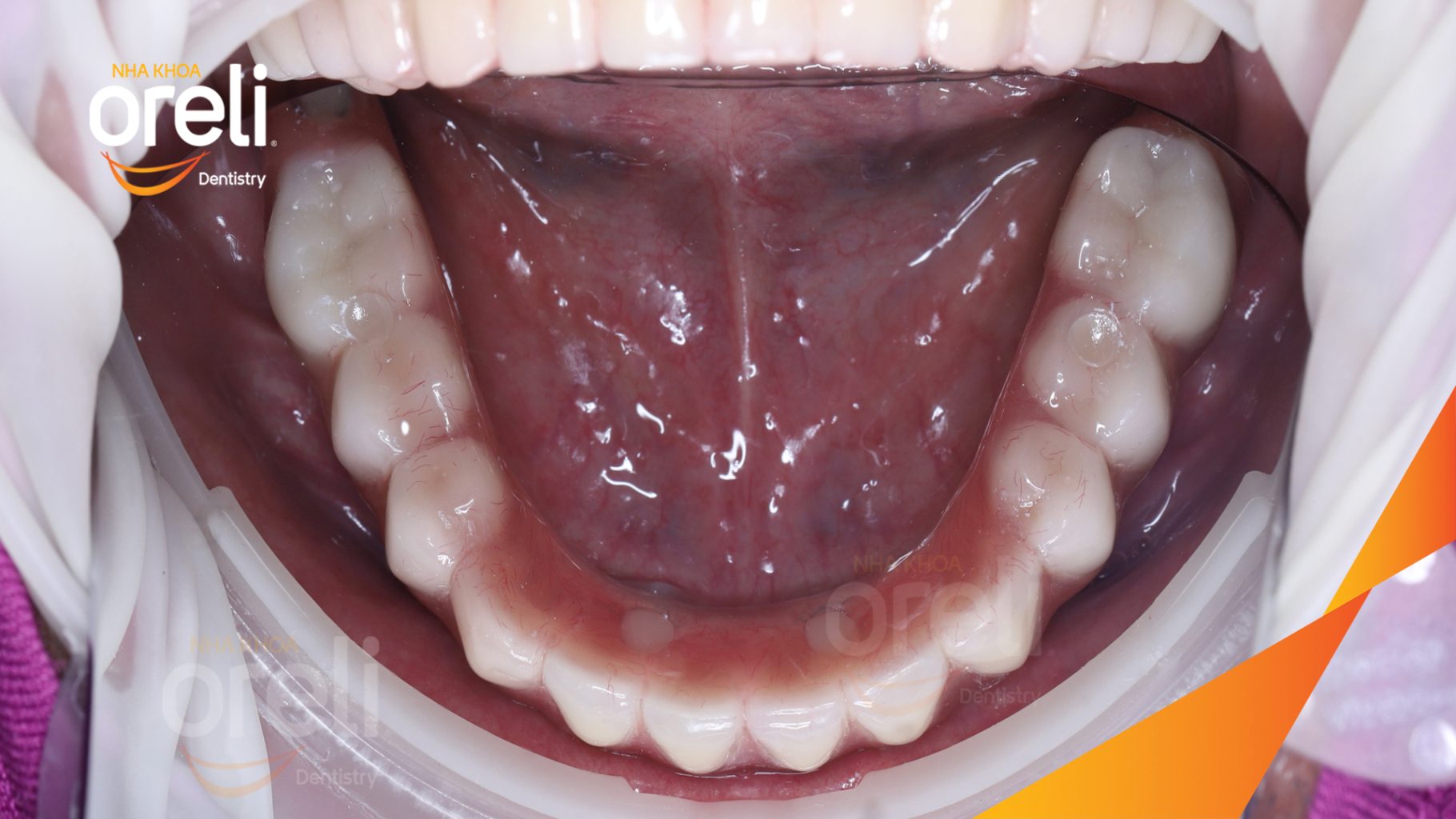 Kết quả đạt được sau 7 ngày - Ăn nhai trở lại và nụ cười thẩm mỹ tại Nha khoa Oreli