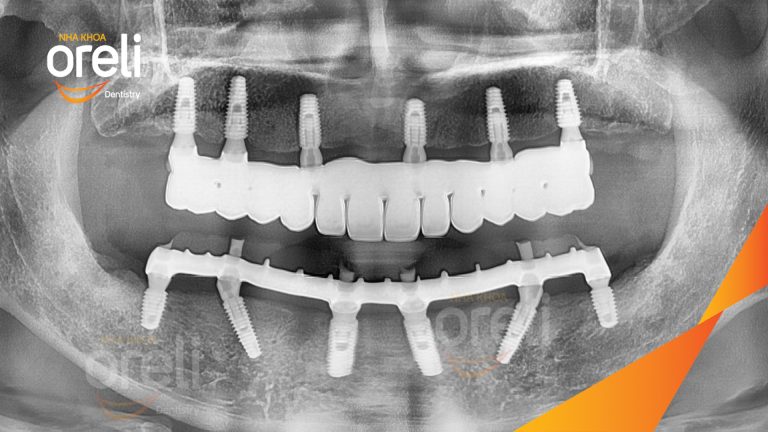 Mất răng toàn hàm ăn nhai khó? Giải pháp All-on-6 tại Oreli