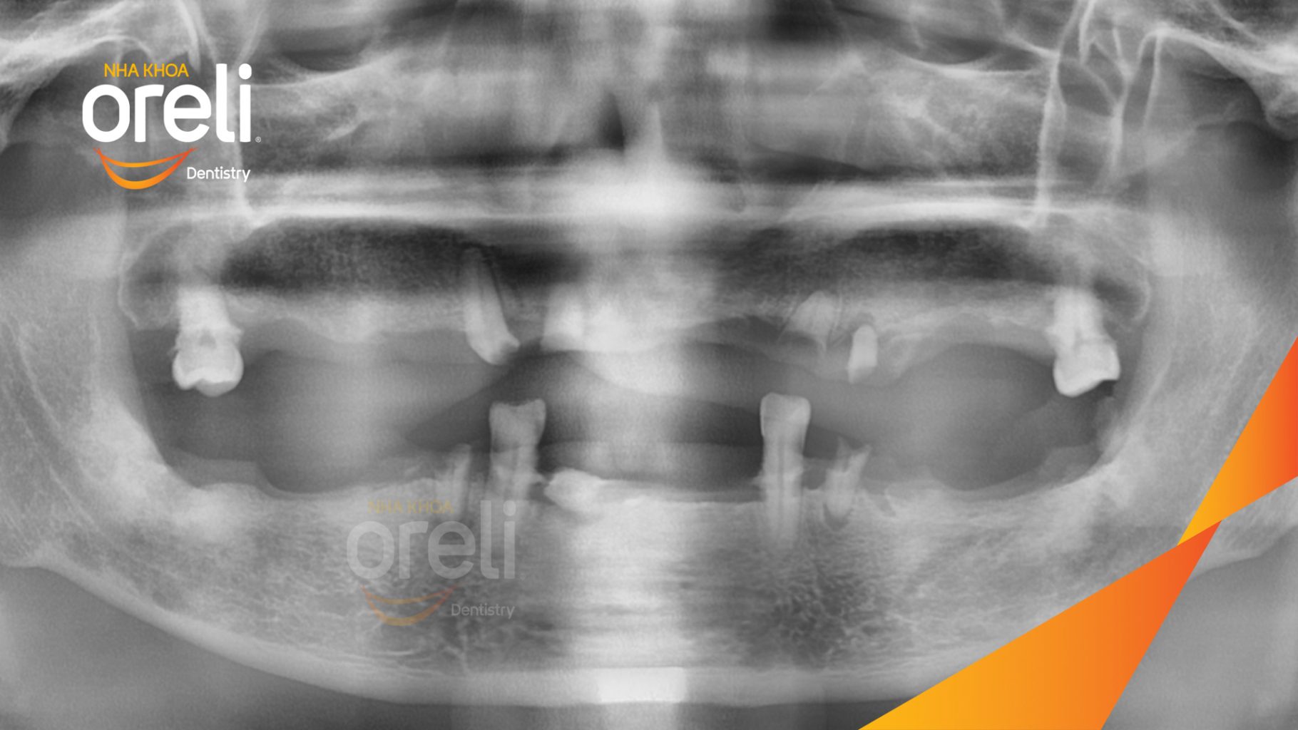 Trước điều trị: Mất răng toàn bộ hàm trên và hàm dưới tại Nha khoa Oreli