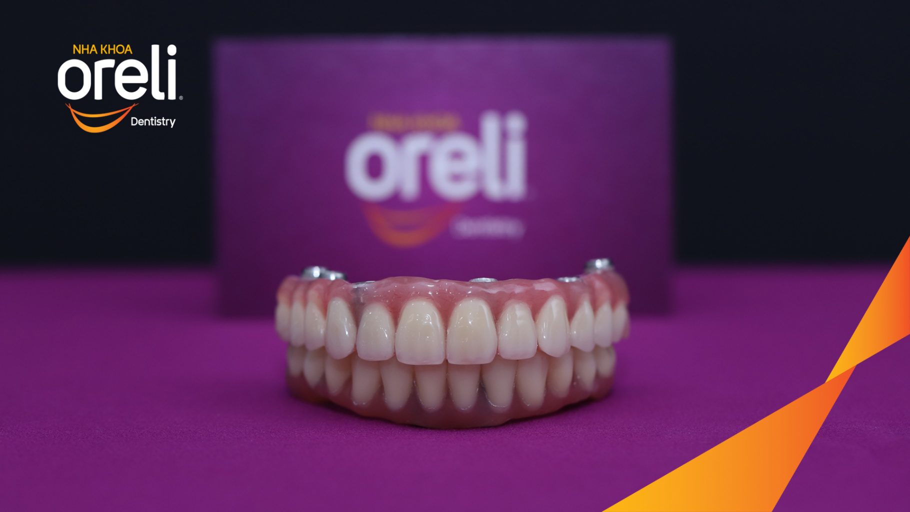 Quá trình Trồng răng implant hai hàm với phục hình tạm trong 7 ngày tại Nha khoa Oreli