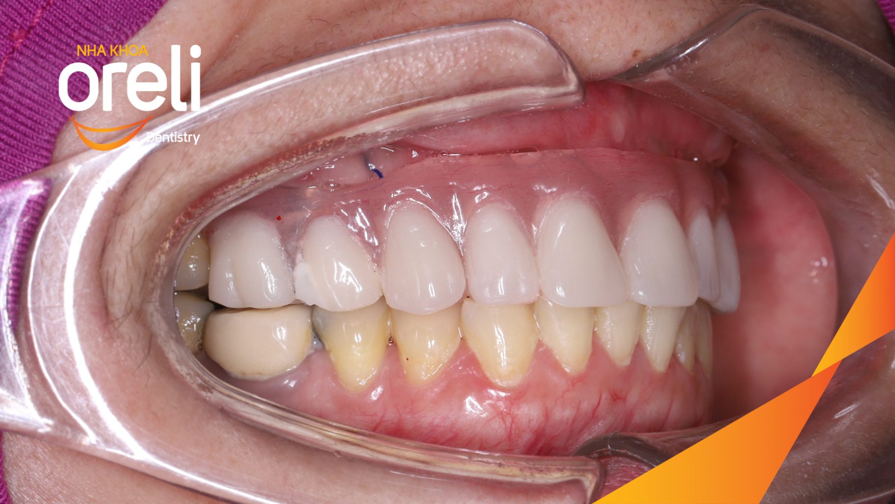 Kết quả sau :  tại Oreli