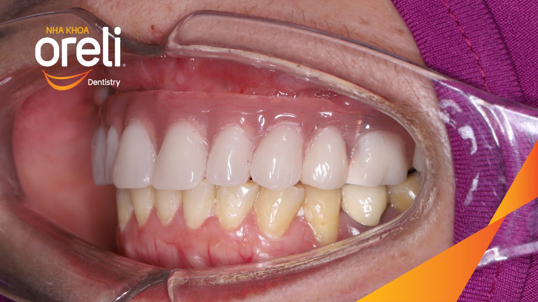 Kết quả đạt được sau  -  tại Oreli