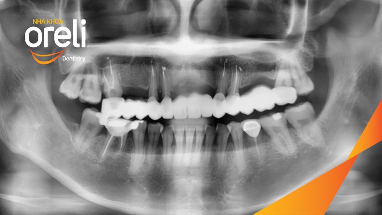 Ca trồng răng Implant all on four hàm trên – Phục hồi ăn nhai chắc chắn | Oreli