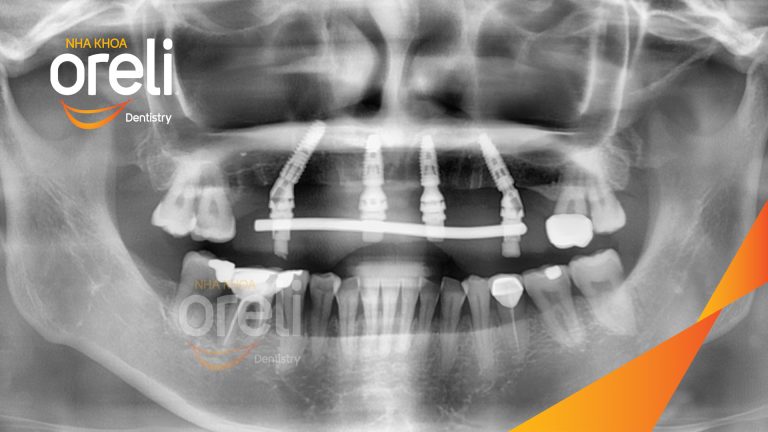 Ca trồng răng Implant all on four hàm trên – Phục hồi ăn nhai chắc chắn | Oreli
