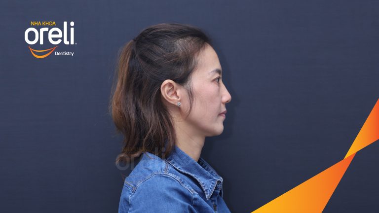 Ca trồng răng Implant all on four hàm trên – Phục hồi ăn nhai chắc chắn | Oreli