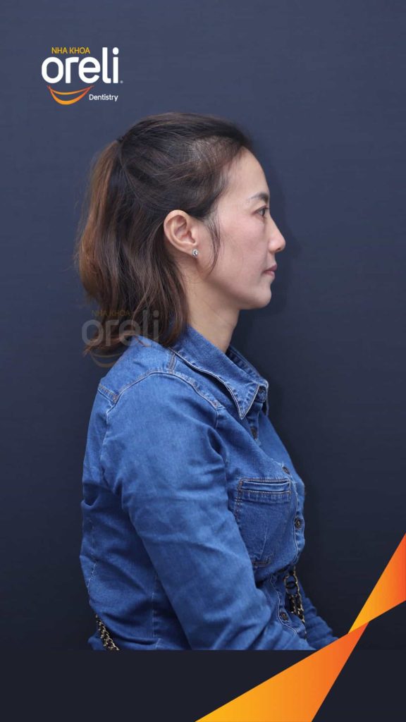 Trước điều trị:  tại Oreli