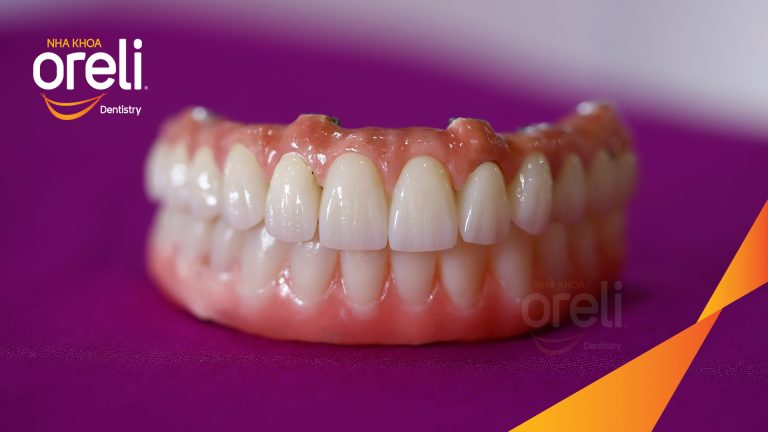 Ca trồng răng hai hàm thay đổi nụ cười và ăn nhai chắc chắn – Kết quả thực tế | Oreli