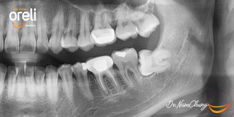 Nhổ răng khôn hàm dưới khó do mọc ngang – Case tại Oreli
