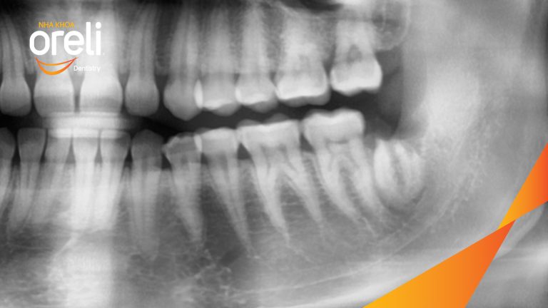 Nhổ răng khôn hai hàm do chen chúc – Ca thực tế tại Oreli