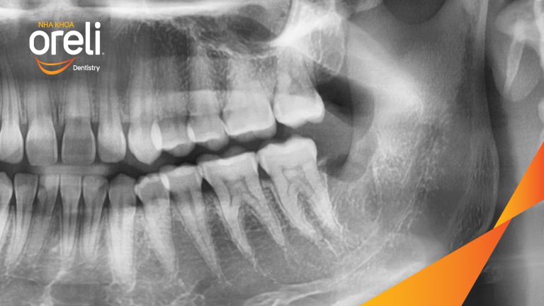 Nhổ răng khôn hai hàm do chen chúc – Ca thực tế tại Oreli