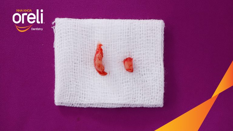 Nhổ răng khôn hai hàm do chen chúc – Ca thực tế tại Oreli