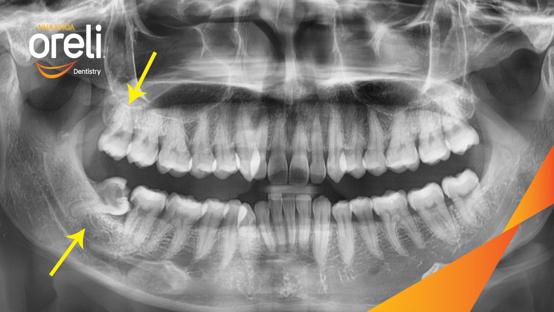 Trước điều trị: Răng khôn hàm dưới sâu vỡ mọc lệch tại Nha khoa Oreli