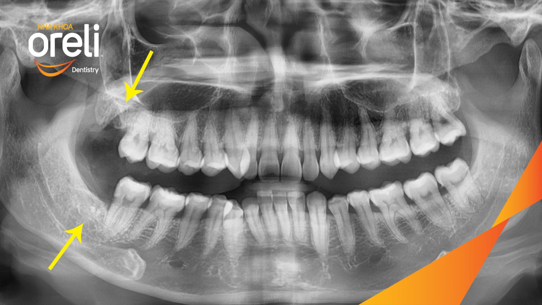 Răng khôn hàm dưới sâu vỡ mọc lệch trước khi điều trị tại Nha khoa Oreli