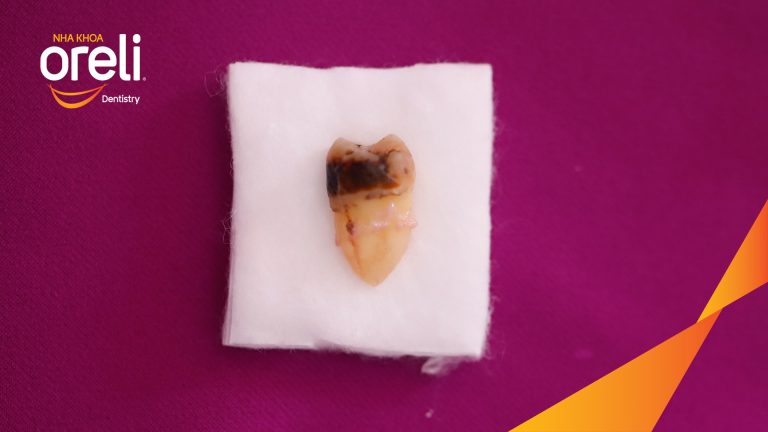 Nhổ răng khôn hàm trên và hàm dưới – Ca điều trị tại Oreli