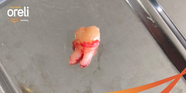 Ca nhổ răng khôn ảnh hưởng răng bên cạnh – Điều trị tại Oreli