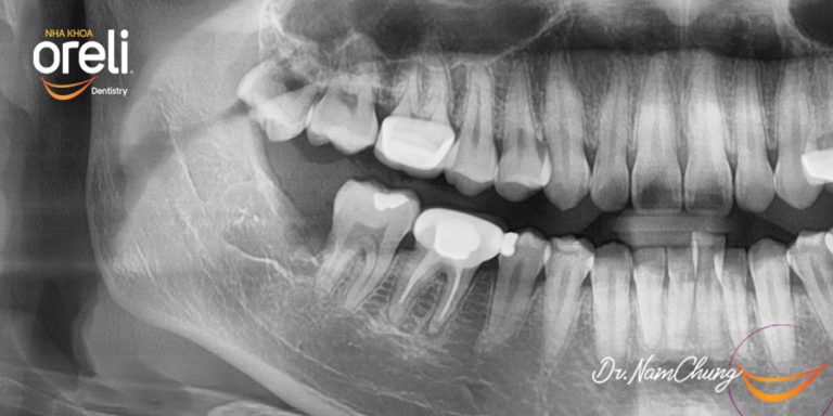 Nhổ răng khôn hàm dưới khó do mọc ngang – Case tại Oreli