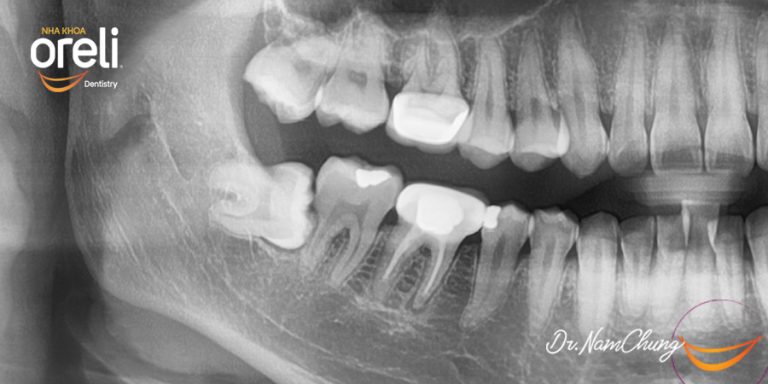 Nhổ răng khôn hàm dưới khó do mọc ngang – Case tại Oreli