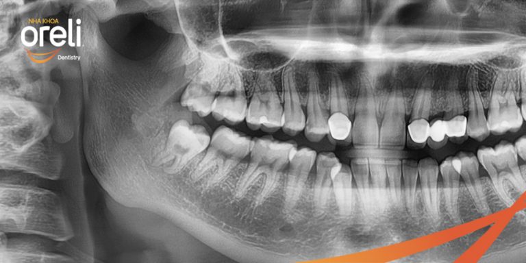 Ca nhổ răng khôn ảnh hưởng răng bên cạnh – Điều trị tại Oreli