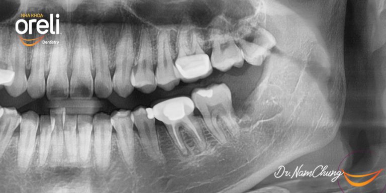 Nhổ răng khôn hàm dưới khó do mọc ngang – Case tại Oreli