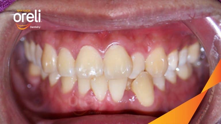 Niềng di gần răng 7 8 thay thế răng 6 hàm dưới bên phải