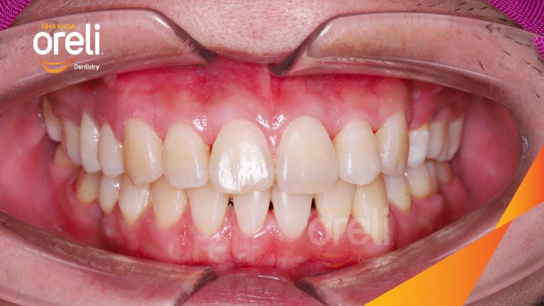 Niềng di gần răng 7 8 thay thế răng 6 hàm dưới bên phải