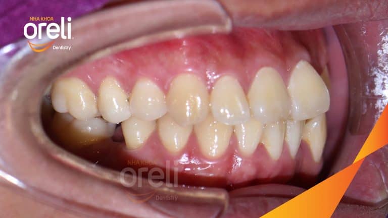 Niềng di gần răng 7 8 thay thế răng 6 hàm dưới bên phải