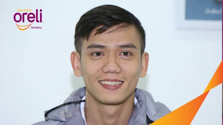 Niềng di gần răng 7 8 thay thế răng 6 hàm dưới bên phải