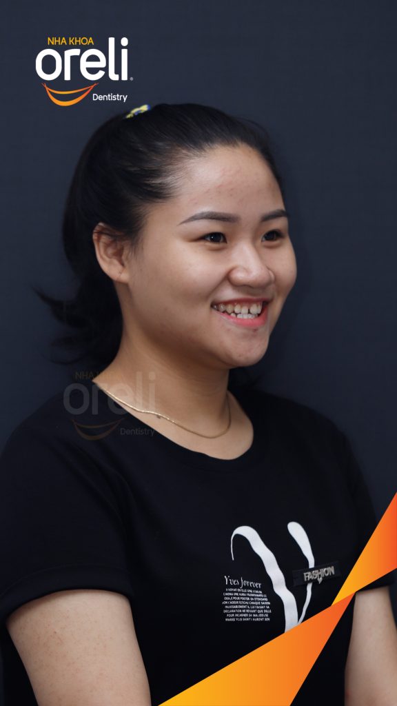 Quá trình Niềng răng không nhổ răng điều chỉnh khớp cắn trong 2 năm tại Nha khoa Oreli