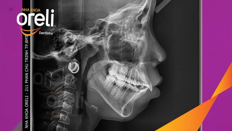 Ca chỉnh hô có nhổ 4 răng 4 thay đổi góc nghiêng đẹp – Kết quả thay đổi sau 3 năm tại nha khoa Oreli