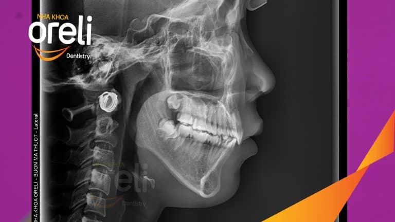 Ca chỉnh hô có nhổ 4 răng 4 thay đổi góc nghiêng đẹp – Kết quả thay đổi sau 3 năm tại nha khoa Oreli