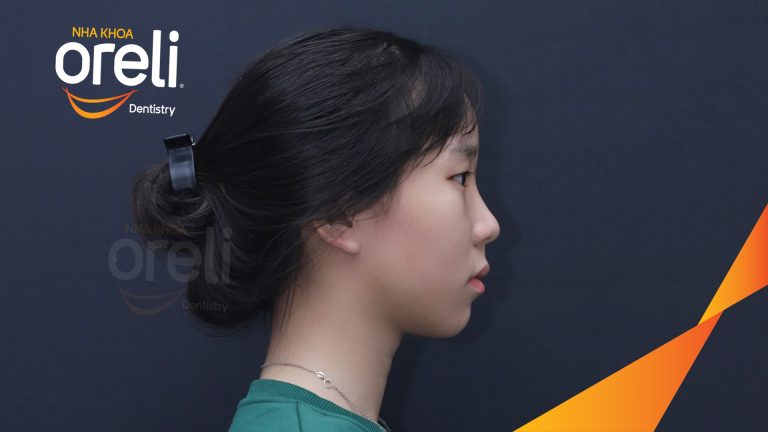 Ca chỉnh hô có nhổ 4 răng 4 thay đổi góc nghiêng đẹp – Kết quả thay đổi sau 3 năm tại nha khoa Oreli