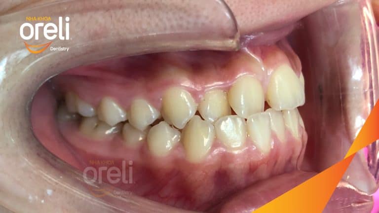 Ca niềng chỉnh chen chúc sai khớp cắn hạng 3 móm nhẹ – Kết quả thực tế ở Oreli