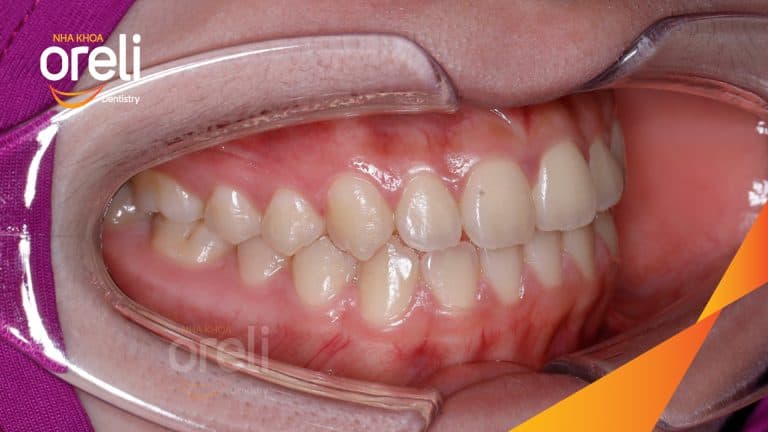 Ca niềng chỉnh chen chúc sai khớp cắn hạng 3 móm nhẹ – Kết quả thực tế ở Oreli