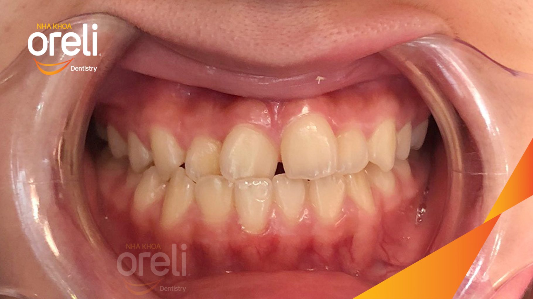 Trước điều trị:  tại Oreli