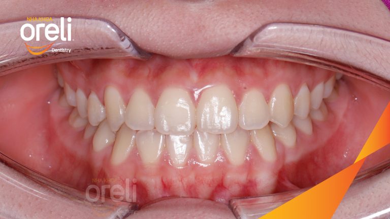 Ca niềng chỉnh chen chúc sai khớp cắn hạng 3 móm nhẹ – Kết quả thực tế ở Oreli