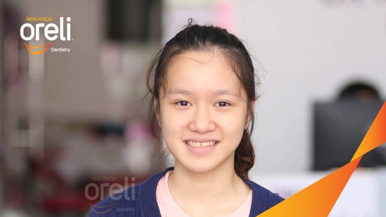 Ca niềng chỉnh chen chúc sai khớp cắn hạng 3 móm nhẹ – Kết quả thực tế ở Oreli