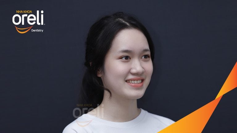 Ca niềng chỉnh chen chúc sai khớp cắn hạng 3 móm nhẹ – Kết quả thực tế ở Oreli