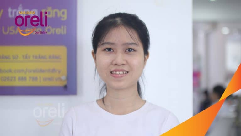 Ca niềng chỉnh hô chen chúc bằng mắc cài kết quả thực tế tại nha khoa Oreli