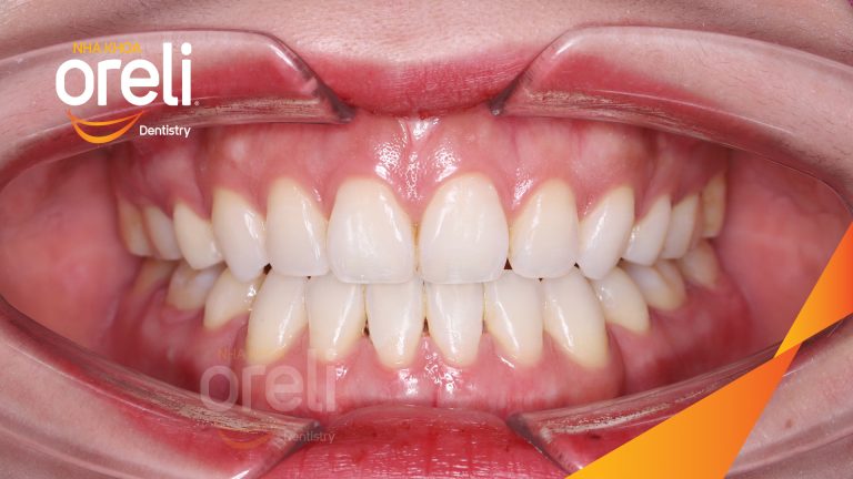 Ca niềng chỉnh cắn hở hô hai hàm kết quả sau 2 năm tại Oreli
