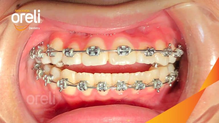 Ca niềng chỉnh cắn hở nặng không nhổ răng ở Oreli