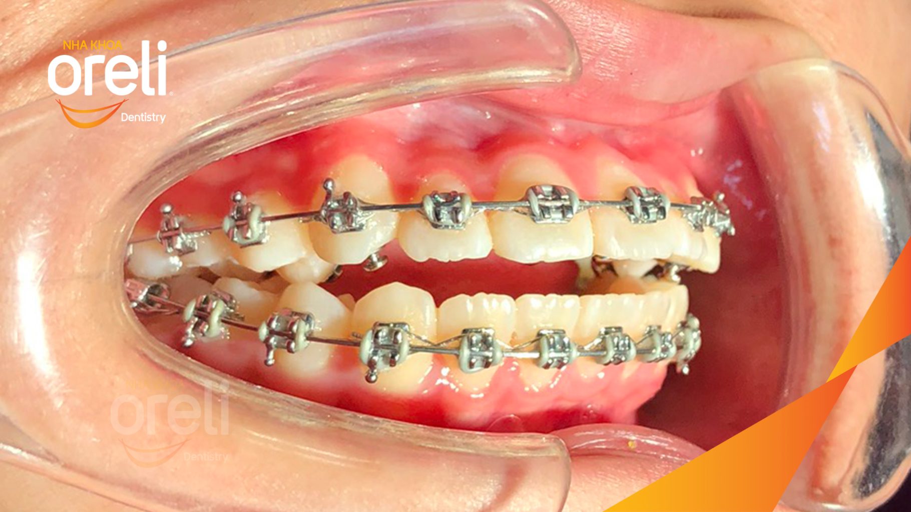 Kết quả sau :  tại Oreli