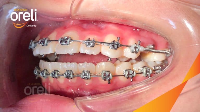 Ca niềng chỉnh cắn hở nặng không nhổ răng ở Oreli