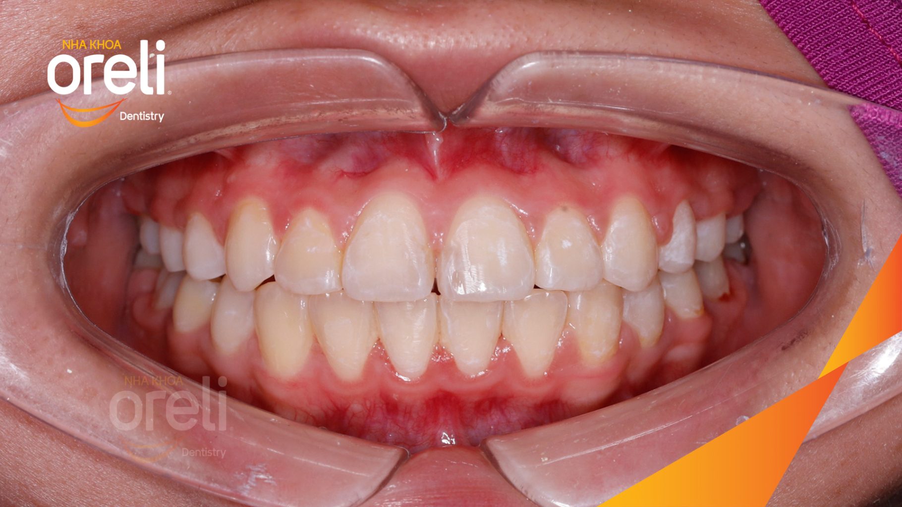  trước khi điều trị tại Oreli