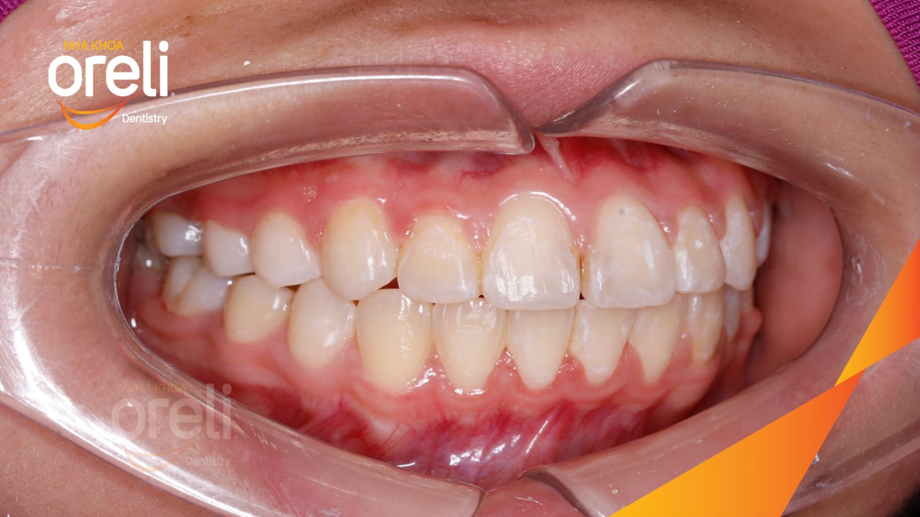 Kết quả đạt được sau  -  tại Oreli