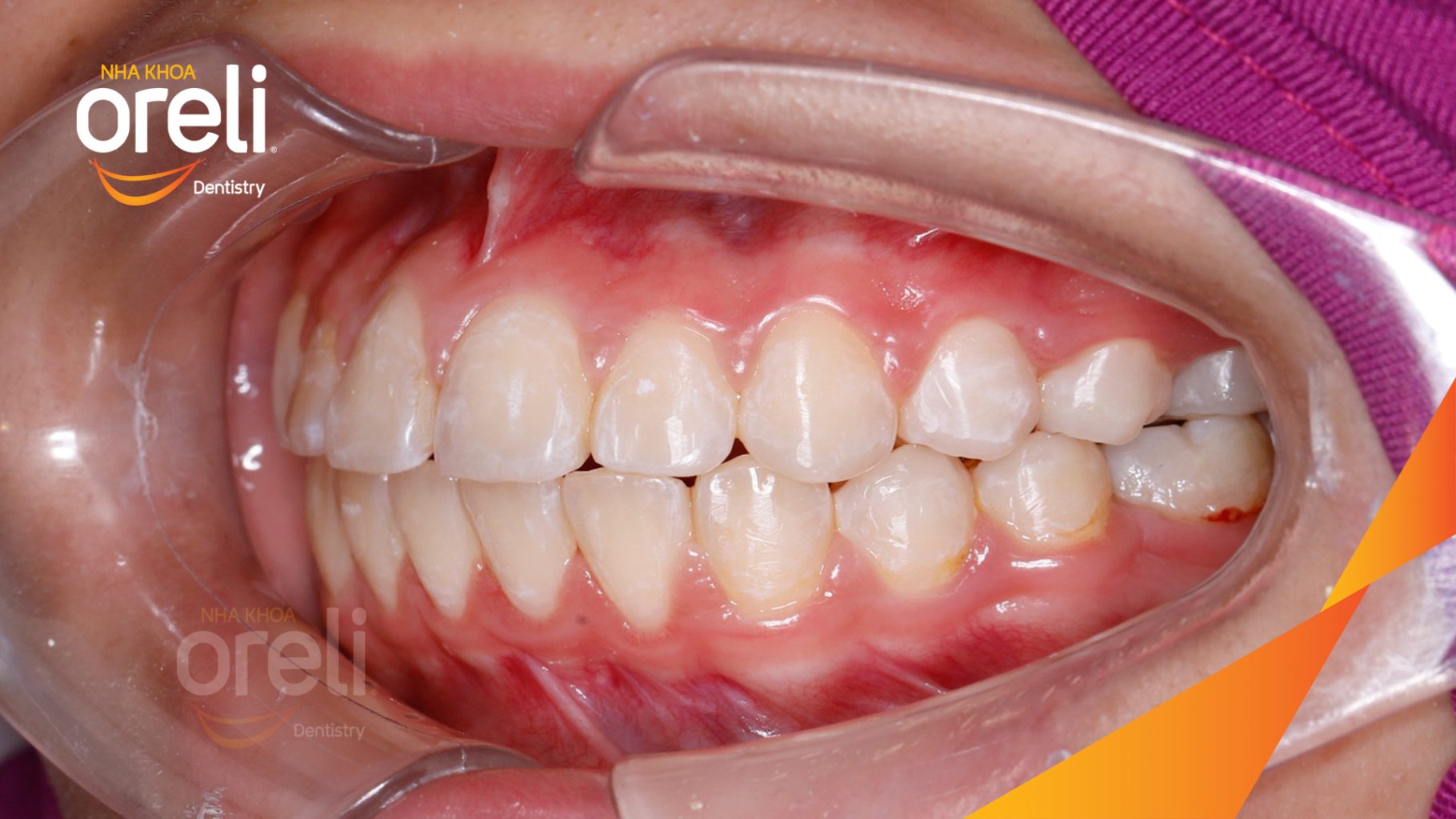 Thực hiện  kéo dài  tại Oreli